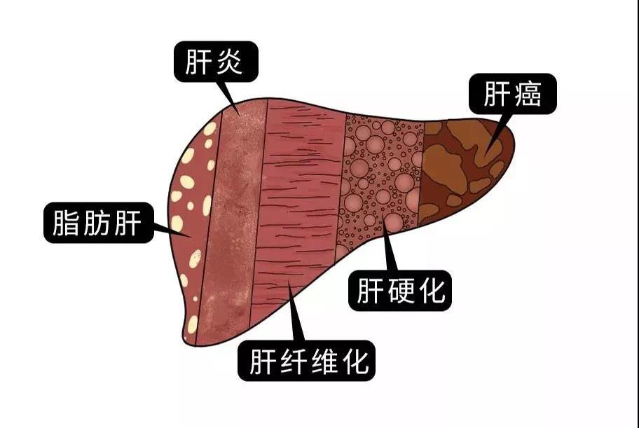 脂肪肝的最大敵人不是肥胖，答案竟是這樣！