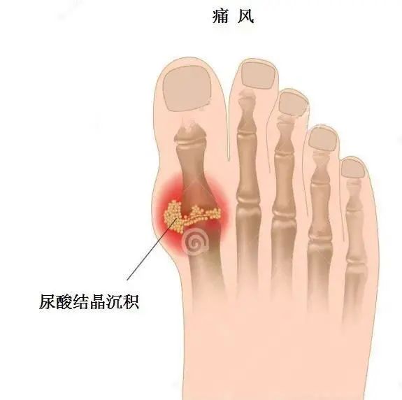 痛風(fēng)為什么偏愛男性？你最關(guān)心的問題都在這里