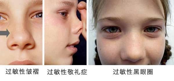過敏性鼻炎會(huì)讓孩子變傻？！家長該如何應(yīng)對(duì)
